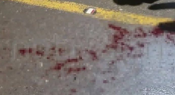 Dedo cercenado en Oruro seria provocado por un salto