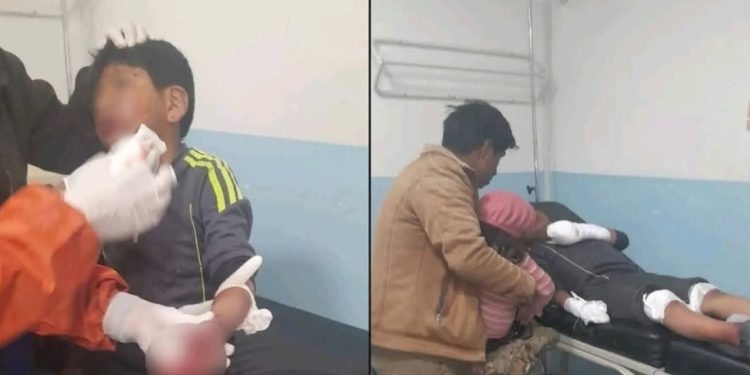 Violencia en protestas alcanza a un menor: niño pierde cinco dedos tras explosión de petardo
